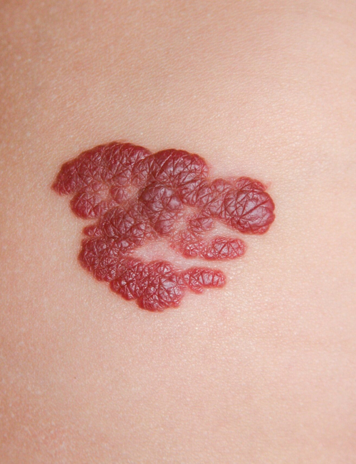 Infantile Hemangioma red birthmark (also called strawberry mark) on the baby's belly. Infantile Hemangiomas (IHs) are the most common tumors of childhood.