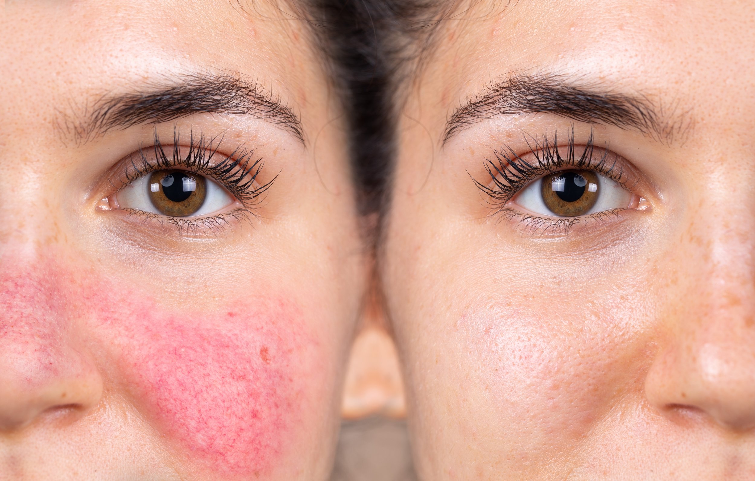Before and after successful rosacea treatment on the face of a c