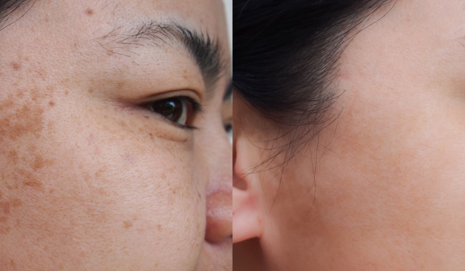 Closeup asian woman face before and after dark spot melasma pigmentation skin facial treatment.Problem skincare and health concept.