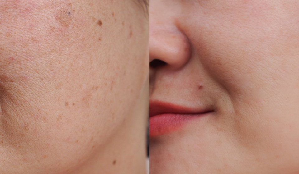 Image before and after spot melasma pigmentation facial treatmen