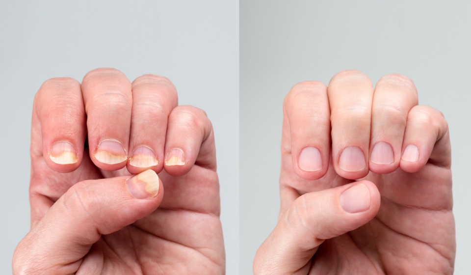 Before and after successful treatment for a onychomycosis or fungal nail infection on damaged nails after gel polish, onychosis. Longitudinal ridging nails with psoriasis, nail diseases