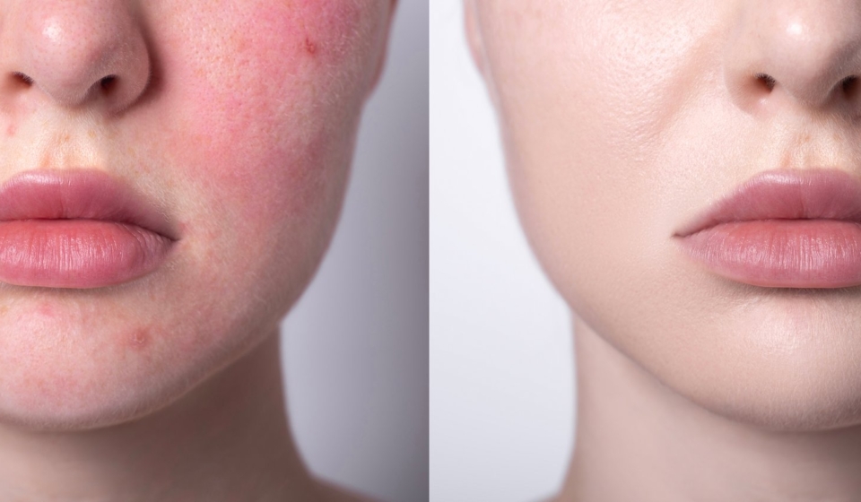 Rosacea couperose redness skin treatment, before and after result of IPL laser treatment, red spots on cheeks, young woman with sensitive skin, patient face close-up