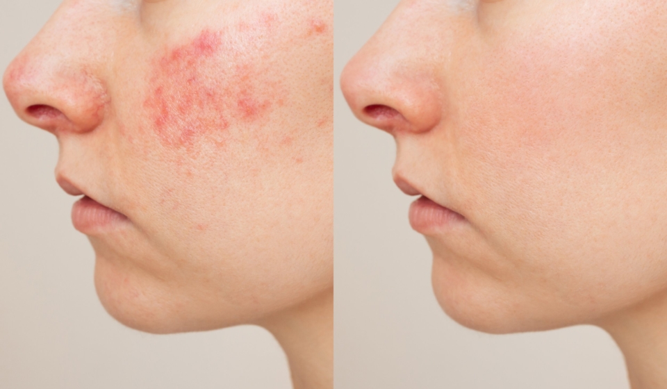 face comparison of a young Caucasian woman suffering from the skin chronic disease rosacea on her face in the acute stage. Before and after treatment. Pink acne. Dermatological problems.