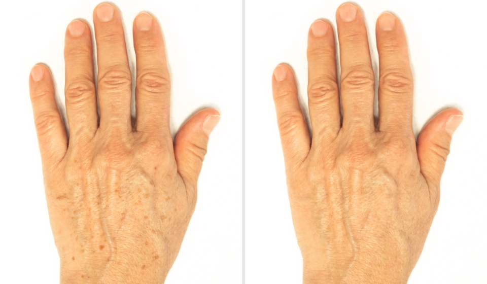 Age spots on the hands before and after removal using a lightening whitening cream. Rejuvenation procedure, laser treatment, peeling. Liver spots, lentigo, sun spots. Cosmetology and beauty concept