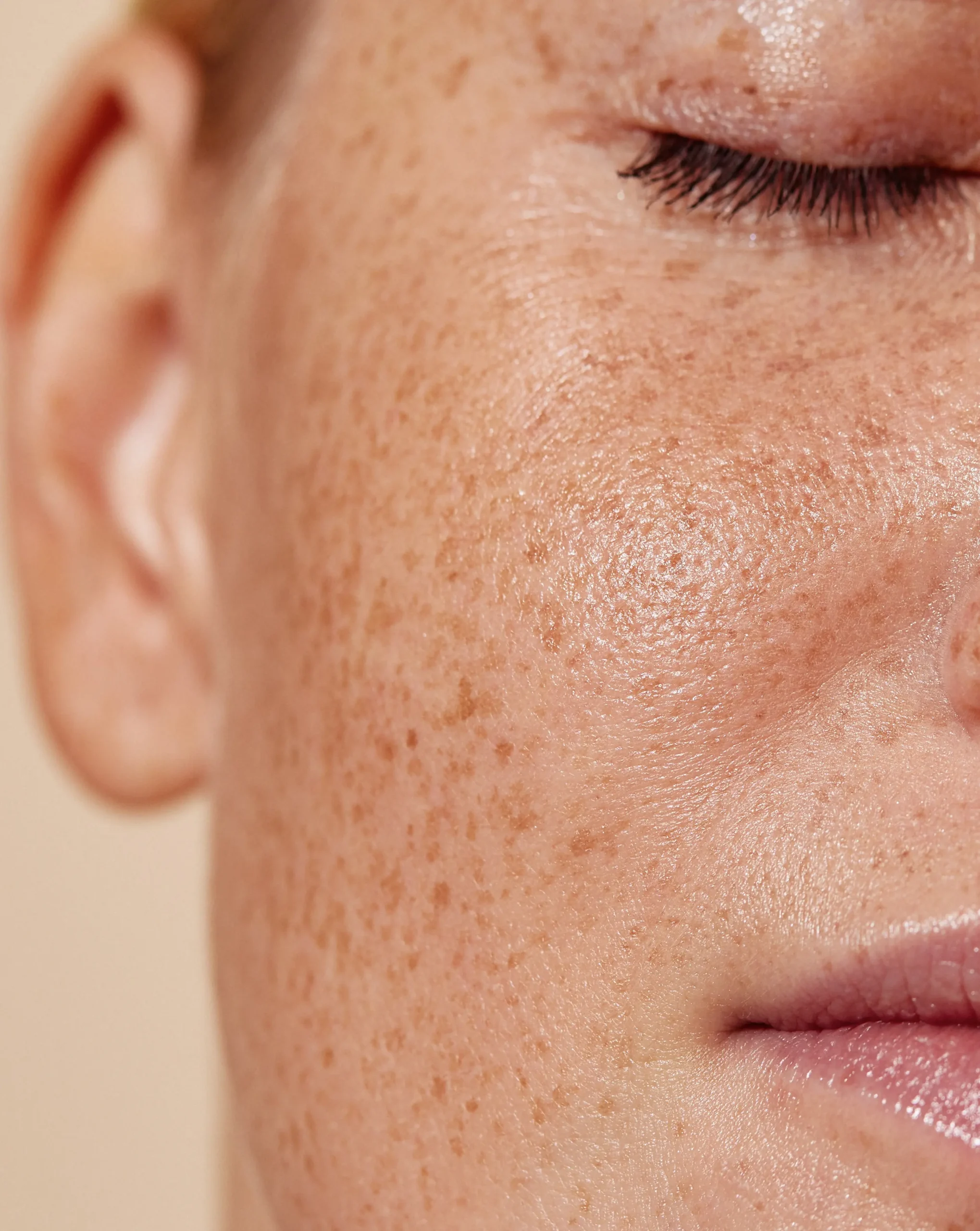 csm_aesthetics-pallas_pigmentflecken_39ea82d969