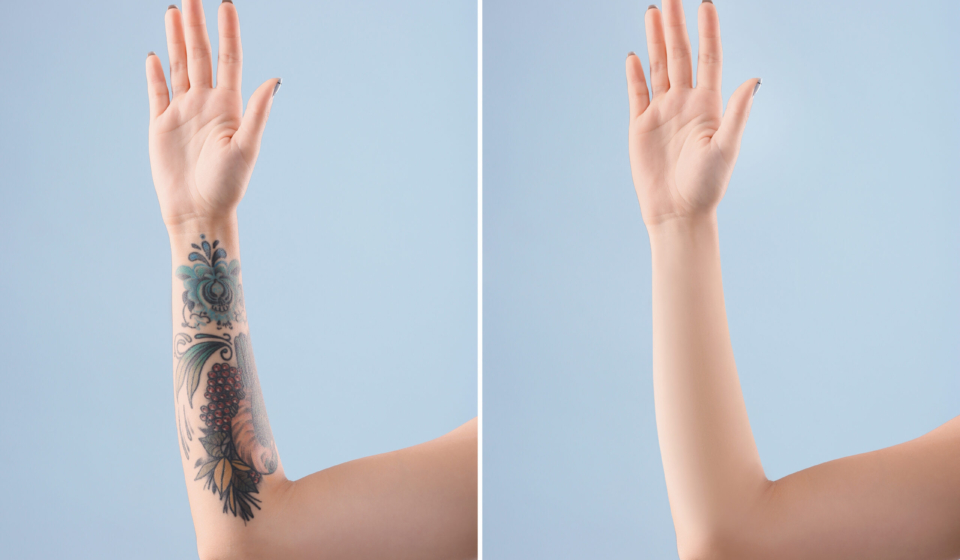 Young woman before and after laser tattoo removal procedure on color background, closeup