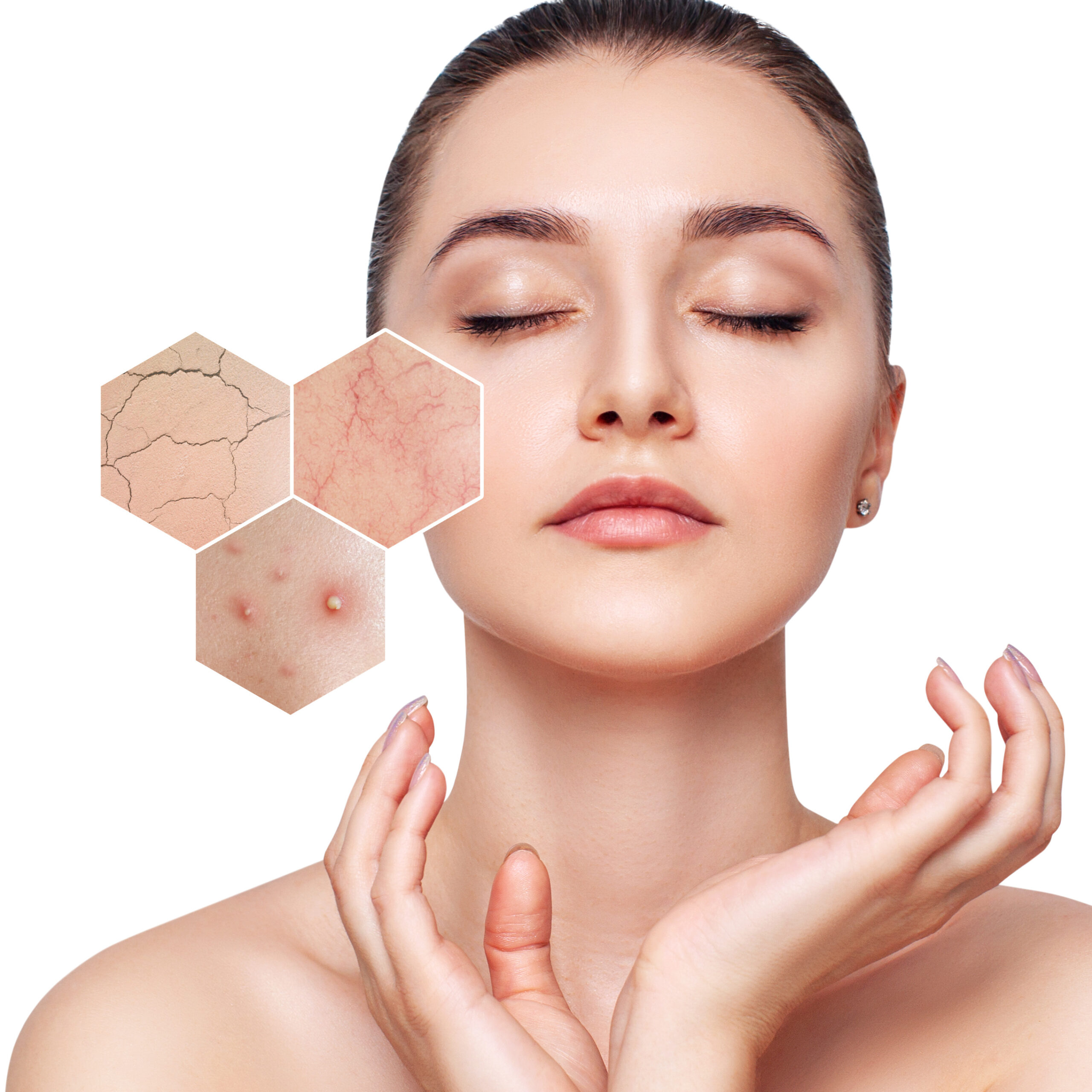 Young woman with couperose and acne on face skin. Zoom hexagon shows skin problems. Isolated on white.