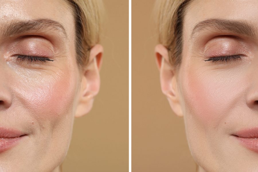 Woman showing face before and after collagen consumption on beige background, closeup. Collage of photos comparing skin condition